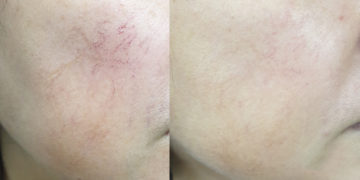 #OK! კლინიკა ,,Skin Code’’ პიგმენტური ლაქების, პოსტ-აკნე ნაწიბურებისა და კაპილარული ქსელის მოცილების უახლეს აპარატურულ მეთოდს გთავაზობთ